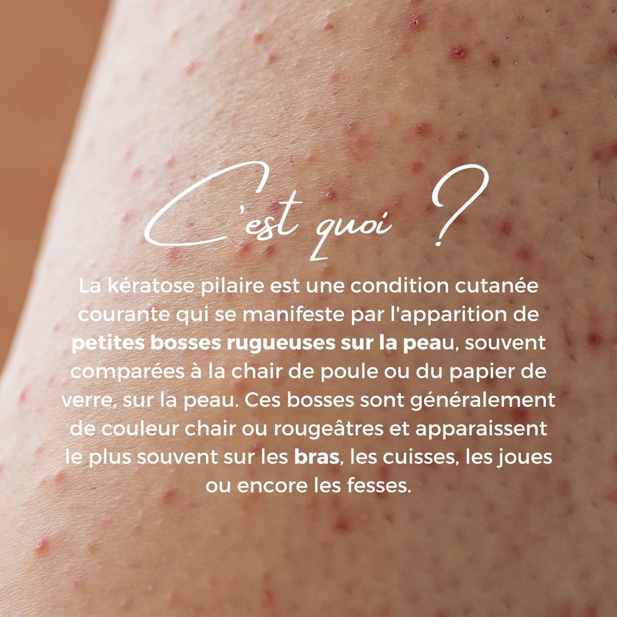 Explication Kératose pilaire-Image2