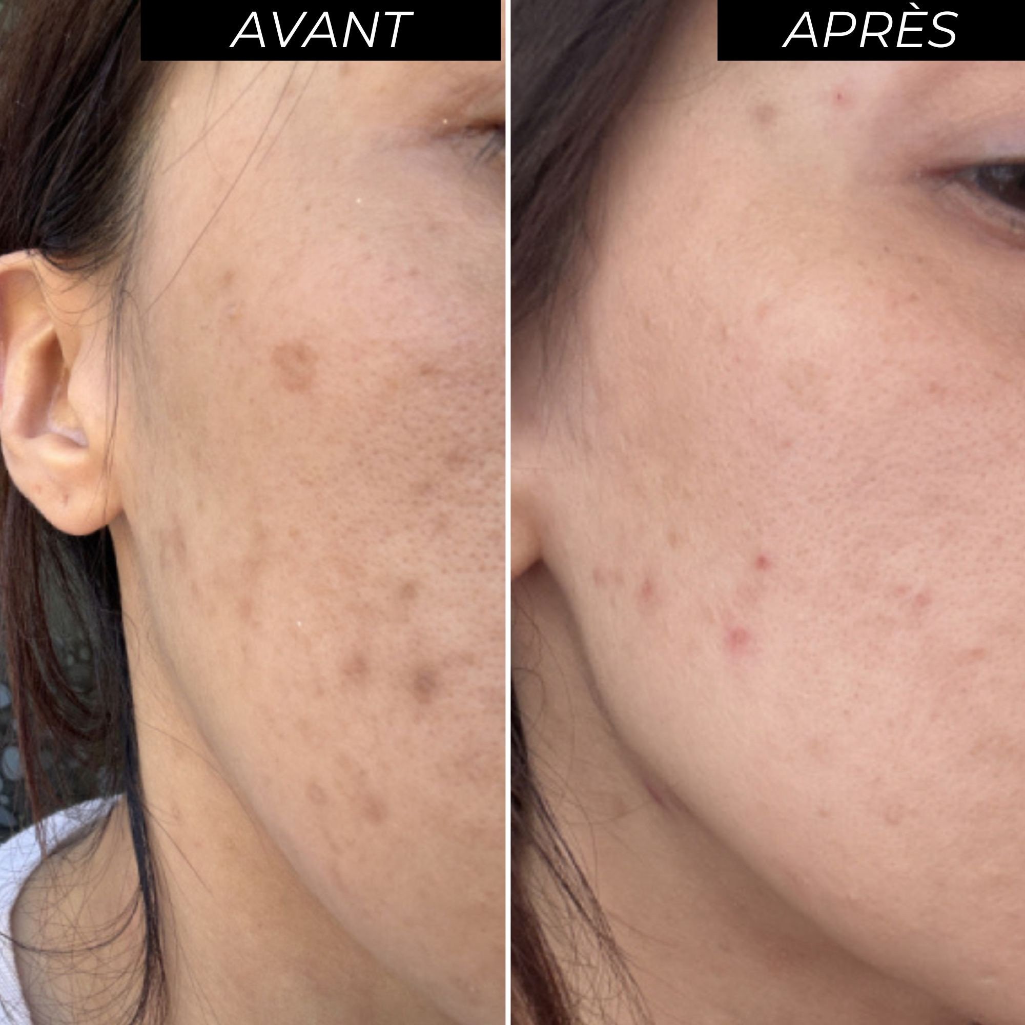 Avant/après kit peeling peau sensible-Image2