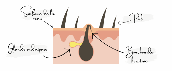 Explication Kératose pilaire